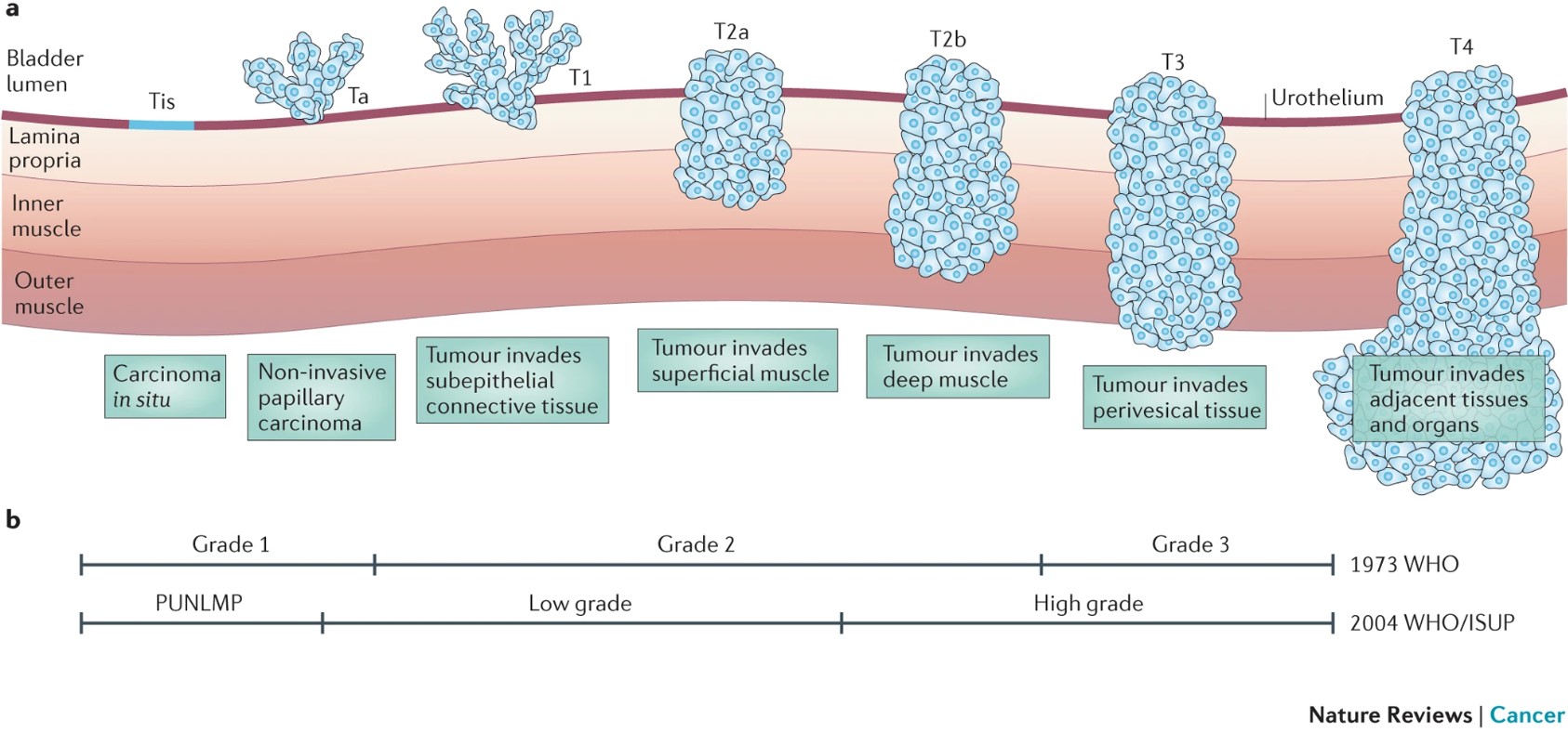 Stages of bladder cancer from Knowles & Hurst, 2015